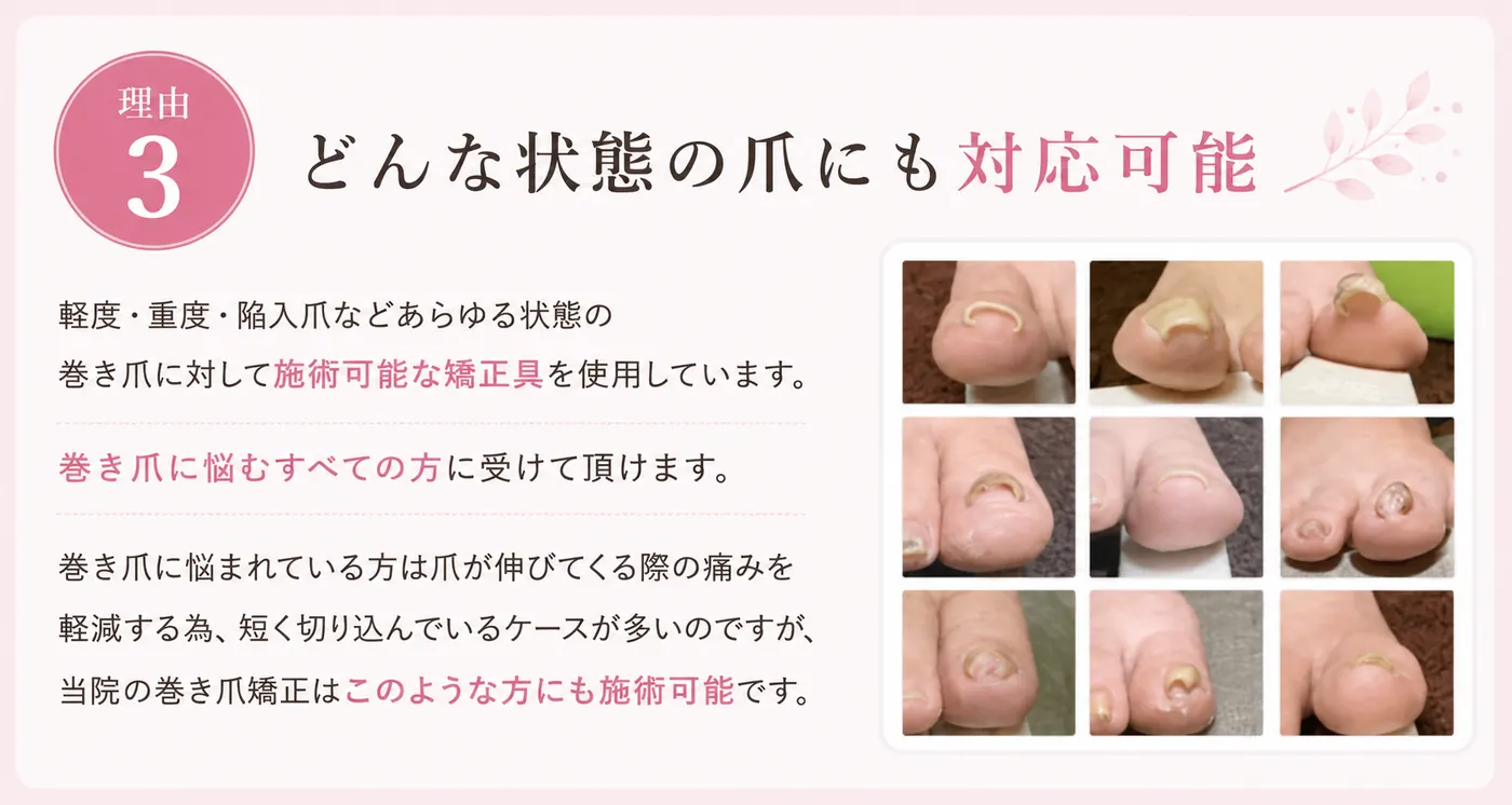 理由3：軽度から重度、陥入爪など幅広い巻き爪のご相談に対応。状態に合わせた矯正具を使用し、当院で対応できるかを確認します。